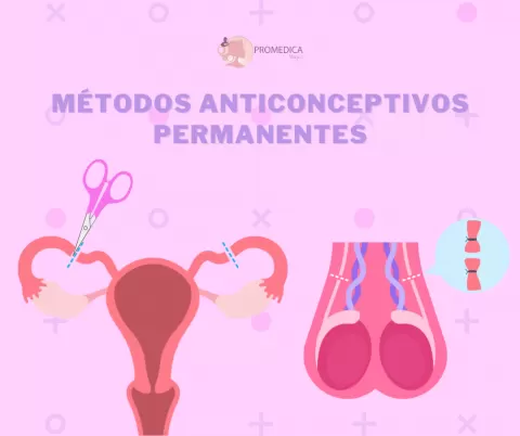 Métodos anticonceptivos permanentes: opciones, ventajas y consideraciones