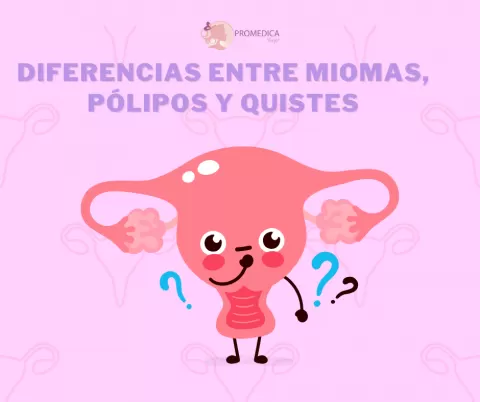 Miomas, quistes y pólipos uterinos: ¿en qué se diferencian?