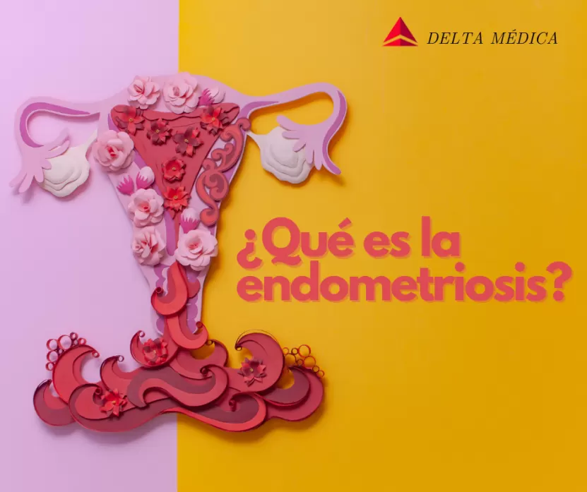 Foto de ¿Qué es la endometriosis?