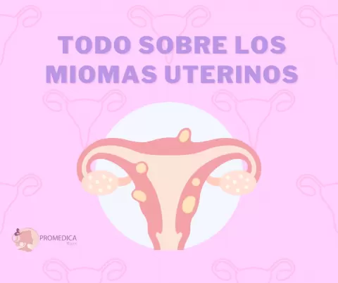 Miomas Uterinos: Detección, Síntomas y Opciones de Tratamiento