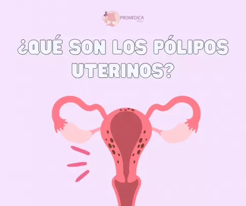 Pólipos Uterinos: Qué Son, Síntomas y Tratamientos