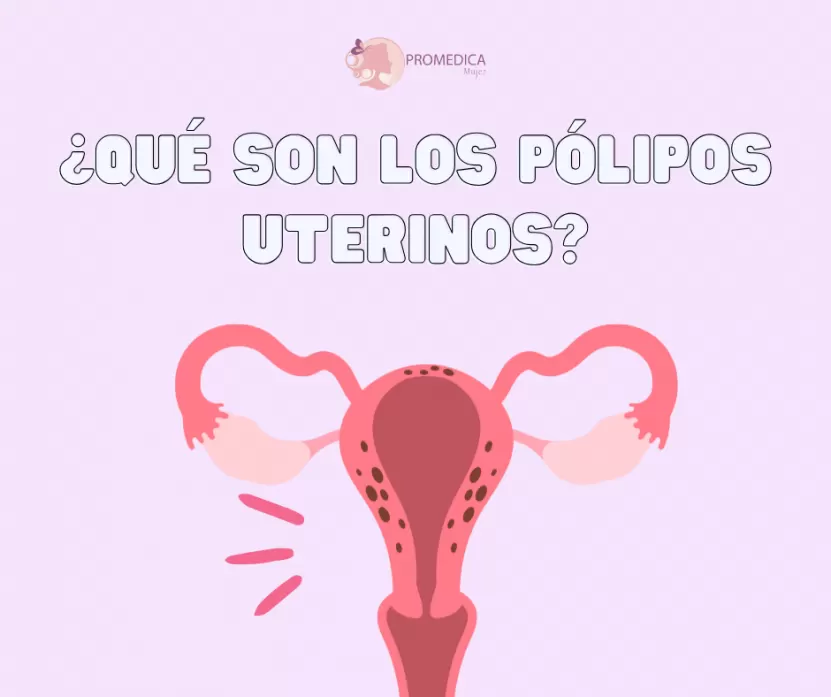 Foto de Pólipos Uterinos: Qué Son, Síntomas y Tratamientos