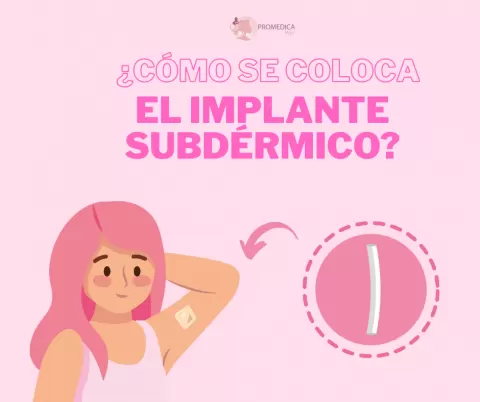 ¿Cómo se coloca un implante subdérmico? 